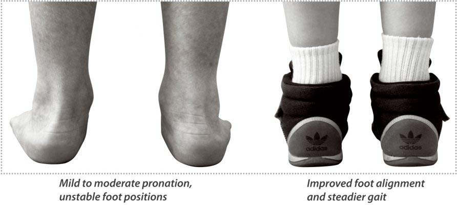 Prefabricated Foot Orthotic